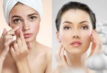 पिंपल फ्री फेस पाने की टिप्स हिंदी में । Pimple free face tips in Hindi Pimple free face tips in Hindi